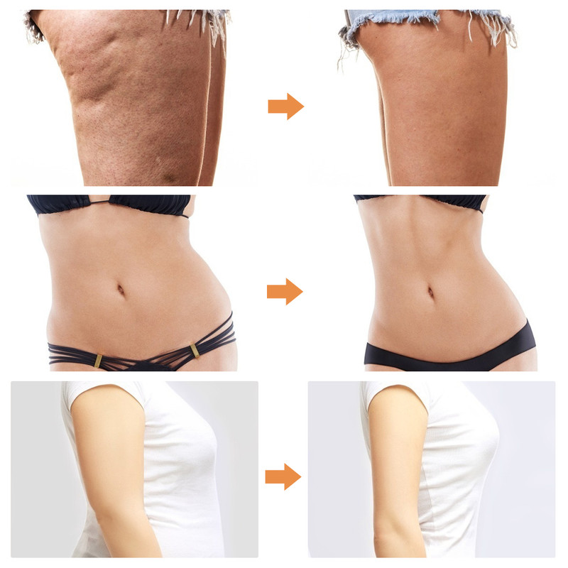 MÁQUINA MASAJEADOR LIPOSUCCIÓN ADELGAZANTE SHAKE LAU - 2