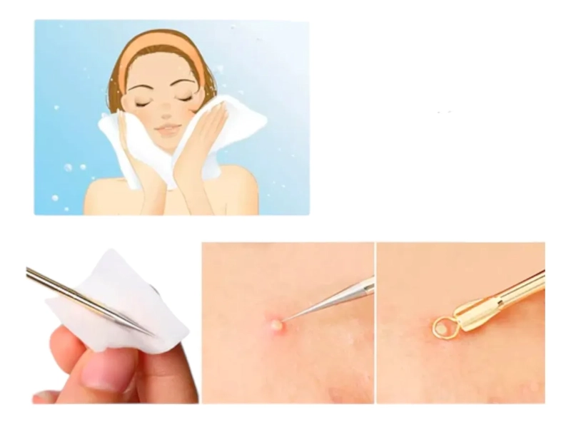 SET HERRAMIENTAS PARA EXTRACTOR DE PUNTOS NEGROS Y ACNE - 4