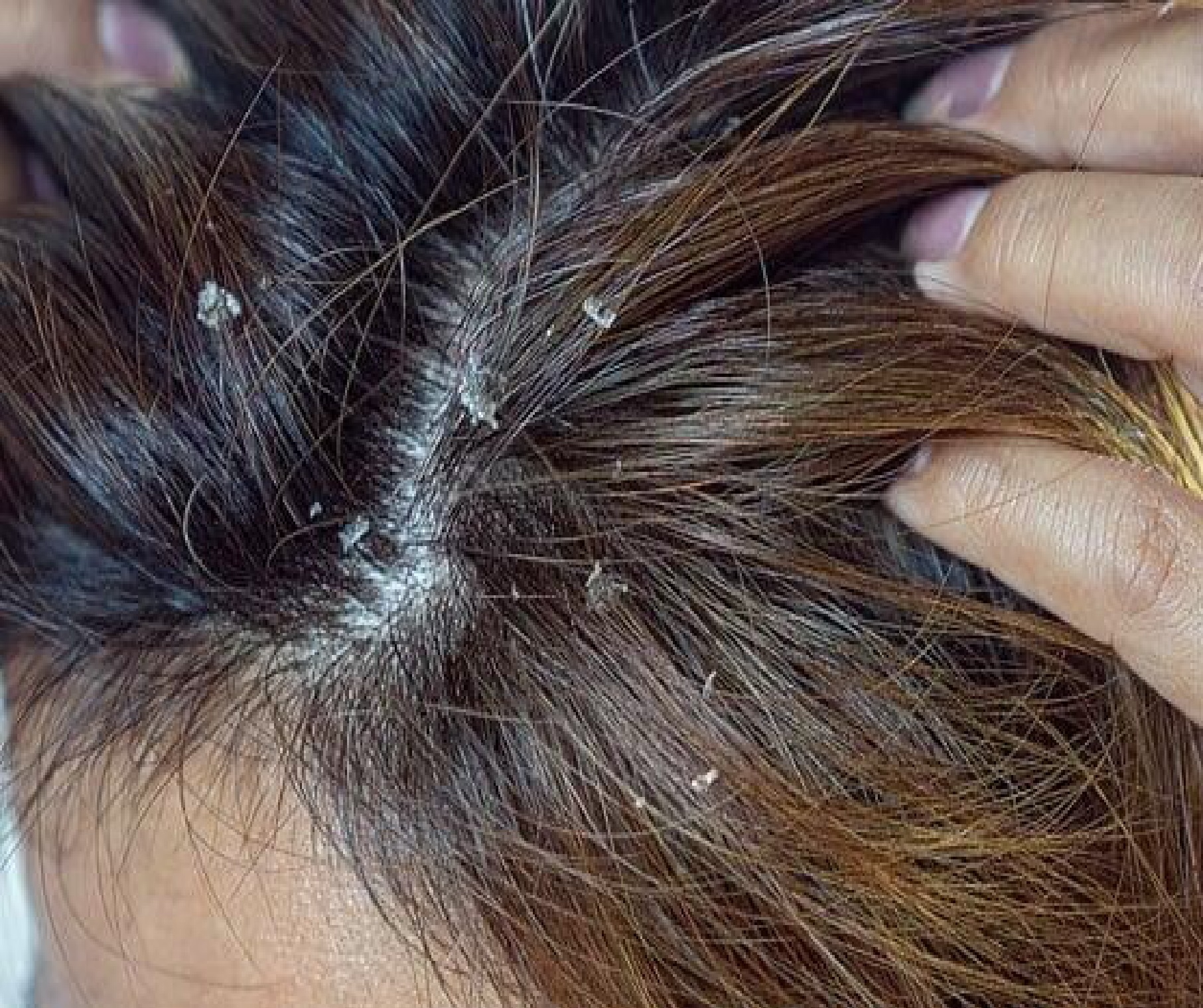 SHAMPOO BIOGEL 1% HIDRATANTE ANTICASPA SEBORREA DERMATITIS 150ML - 3