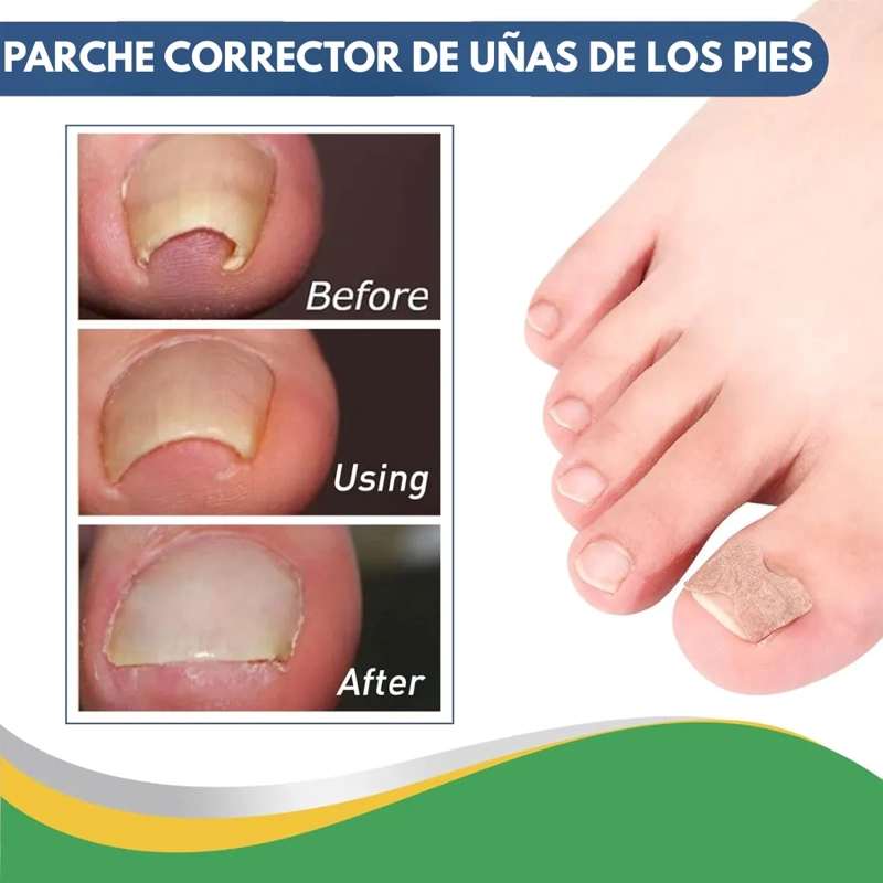 PACK 50 PARCHES UÑAS ENCARNADAS CORRECTOR DE CRECIMIENTO - 2