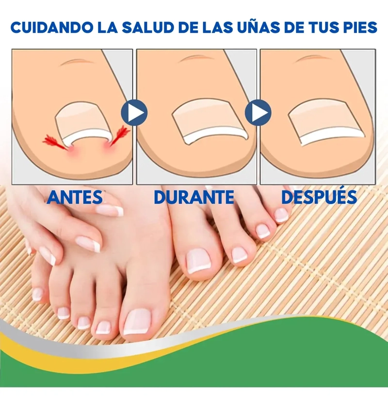 PACK 50 PARCHES UÑAS ENCARNADAS CORRECTOR DE CRECIMIENTO - 3