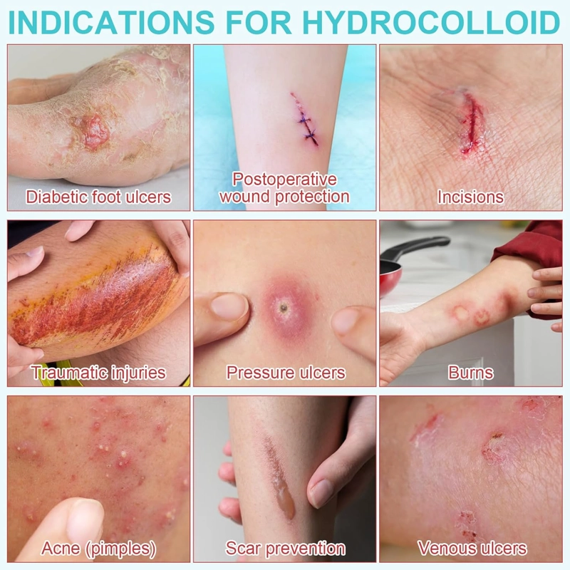 ROLLO HIDROCOLOIDE CUIDADO HERIDAS, AMPOLLAS, ACNE  5 CM X 1,5 MT - 5