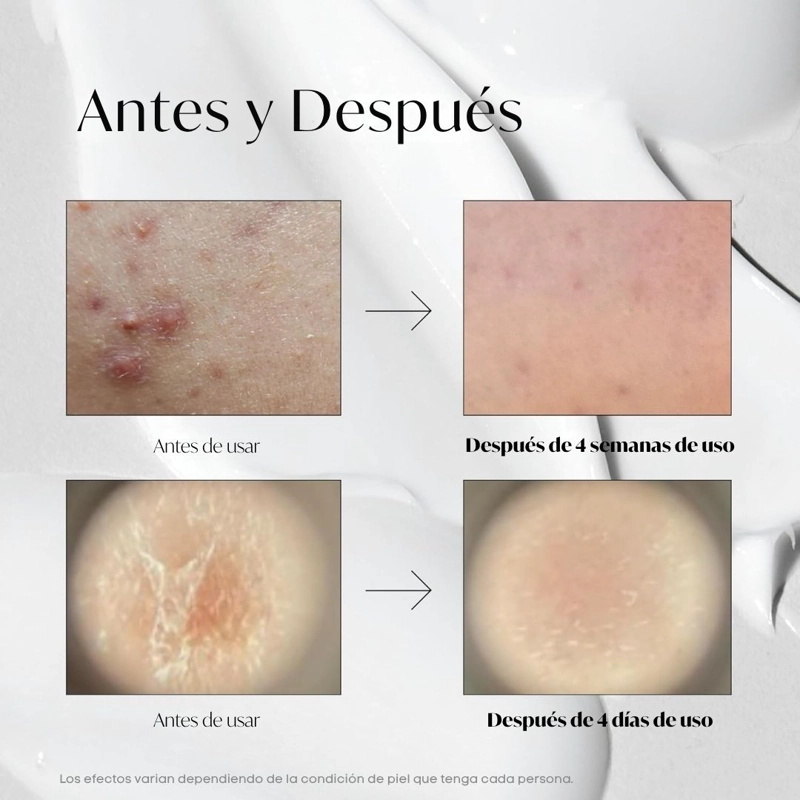 SERUM COREANO DE MICROAGUJAS VT COSMETICS REEDLE SHOT 100 - 5