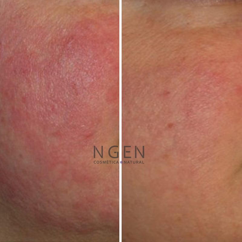 CREMA FACIAL ROSTRO Y CUELLO NGEN 100 ML ANTIROJECES CALMANTE E HIDRATANTE - 3