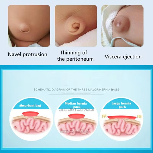 KIT 2X CINTURÓN TRATAMIENTO HERNIA UMBILICAL FAJA BANDA BEBÉ / CELESTE - 5