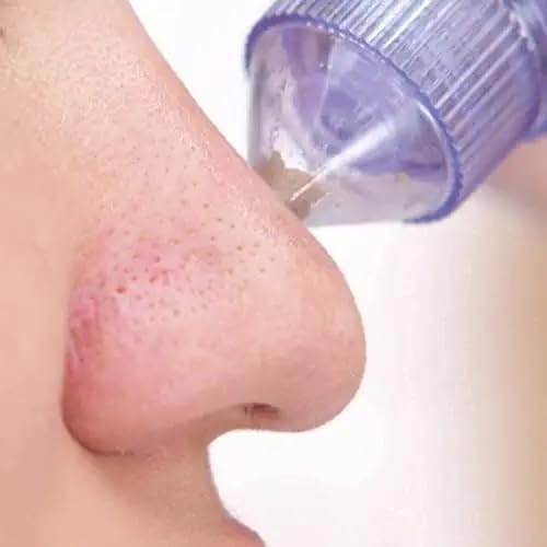 LIMPIADOR FACIAL SUCCIONADOR PUNTOS NEGROS ACNÉ RONDON - 5