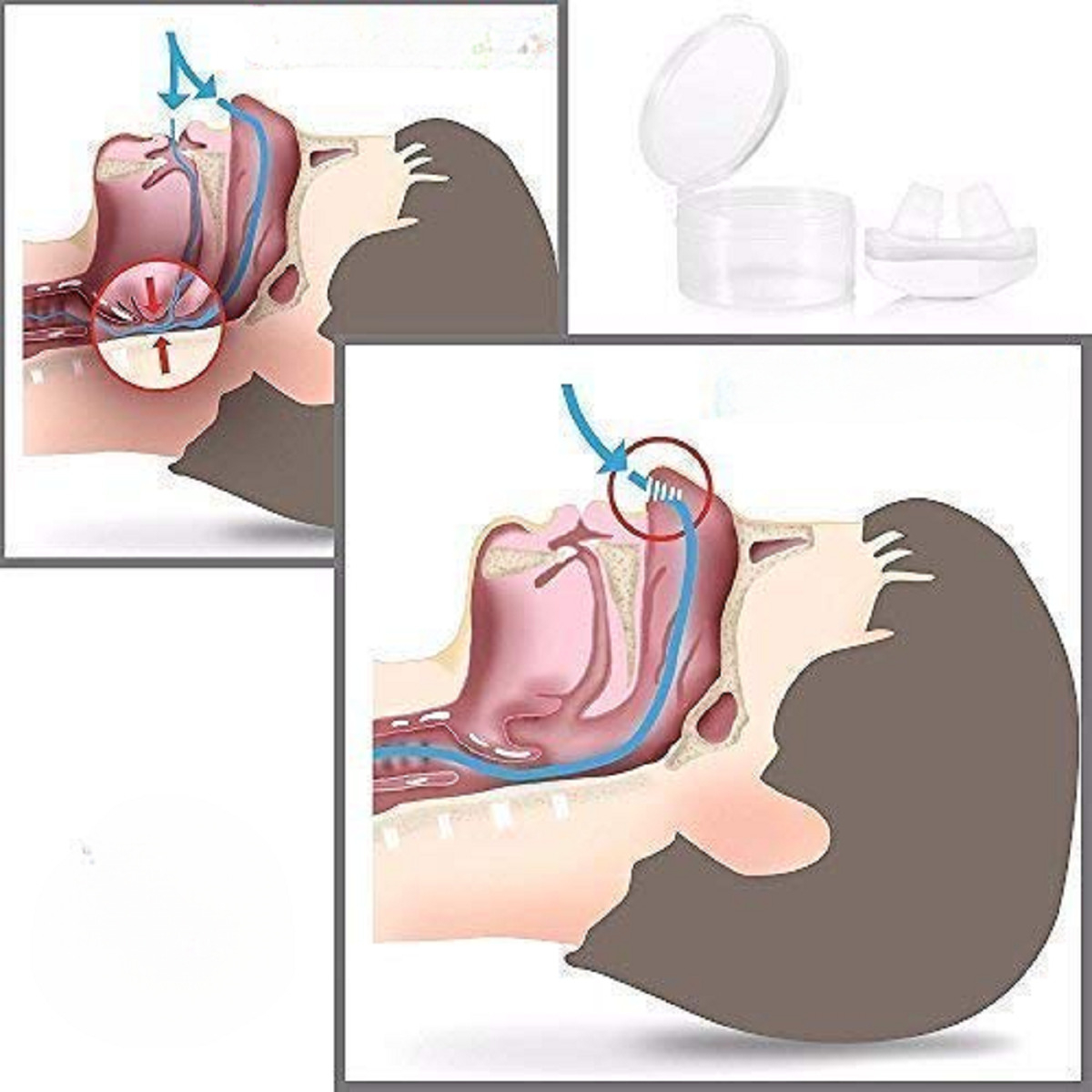 SET 6 DISPOSITIVO ANTIRRONQUIDO 2 EN 1 NASAL PURIFICADOR LAU - 3