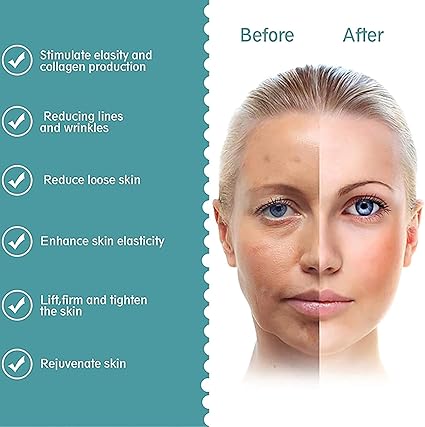 MINI HIFU MÁQUINA DE RADIOFRECUENCIA FACIAL RFLIFTING - 4