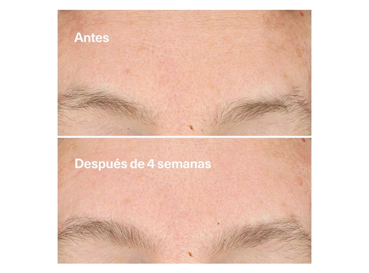 EXFOLIANTE FACIAL CLINIQUE LIMPIADOR CLARIFYING DO OVER PEEL 30 ML - 5